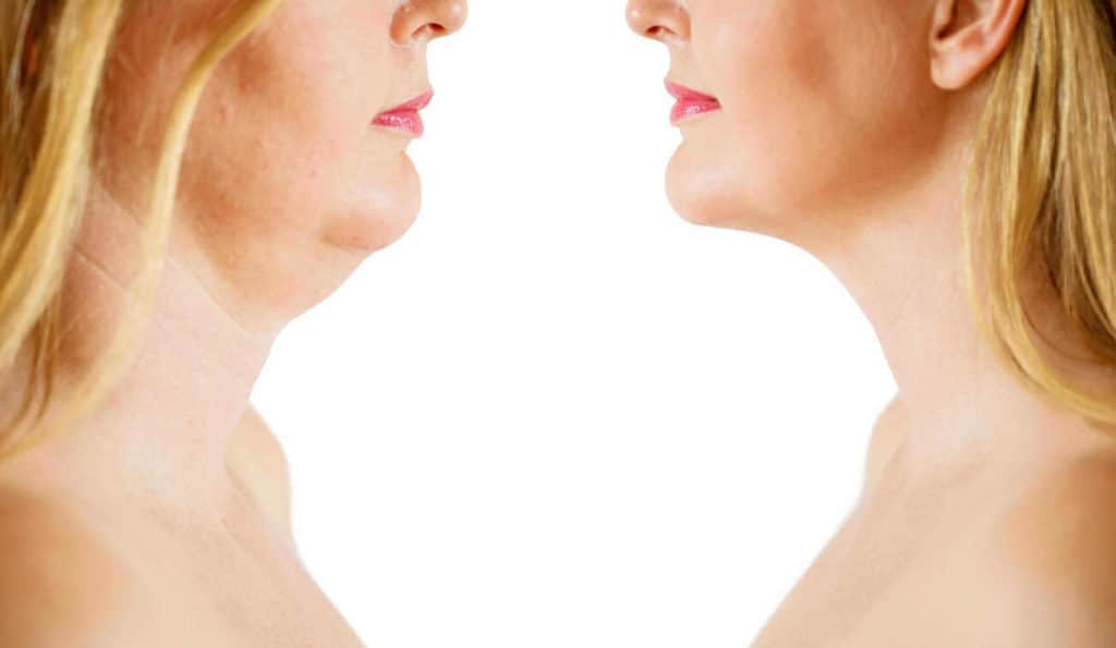 Double Chin treatment Newbury before and after results
