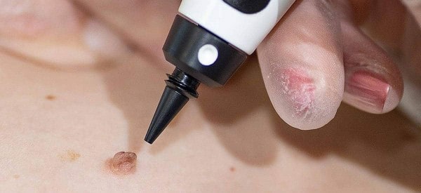 After Skin Tag Removal Newbury