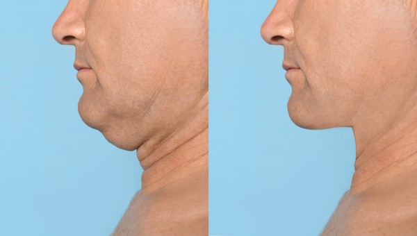 Which Non-Surgical Treatments Work Best for Jowls and Loose Skin Newbury?