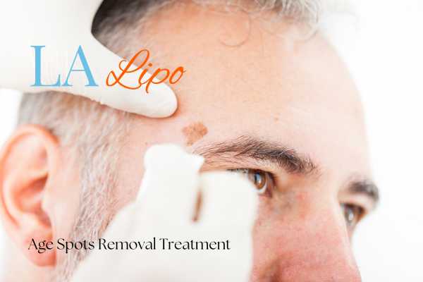 What Are the Most Effective Treatments for Age Spots Newbury?