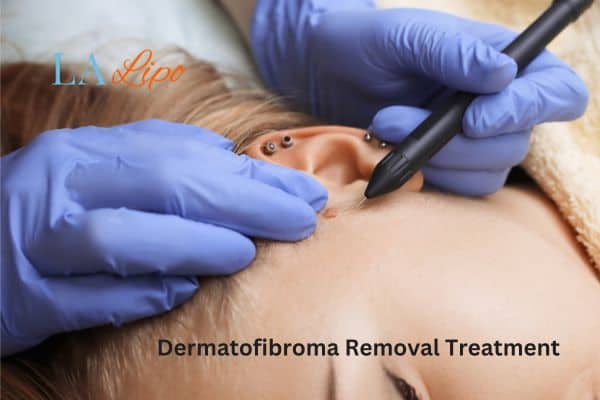 Dermatofibroma Removal Treatment Newbury