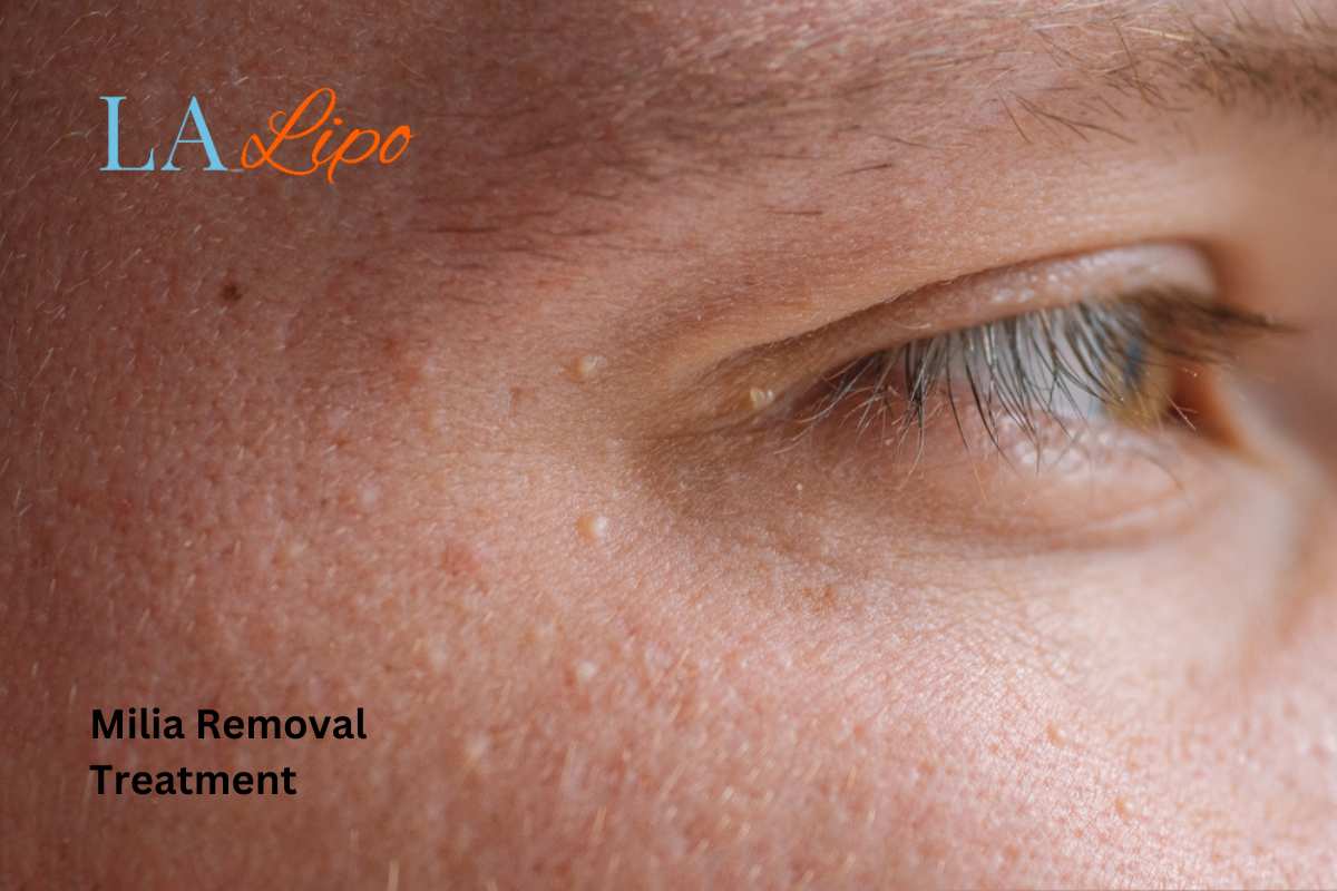 Cryopen Milia Removal: Is It the Easiest and Safest Option Newbury?