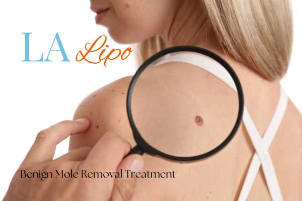 Why getting moles removed Newbury can boost your confidence!
