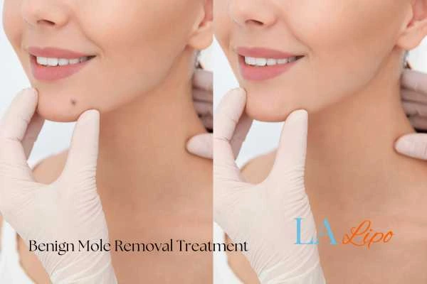 woman's before and after mole removal Newbury results