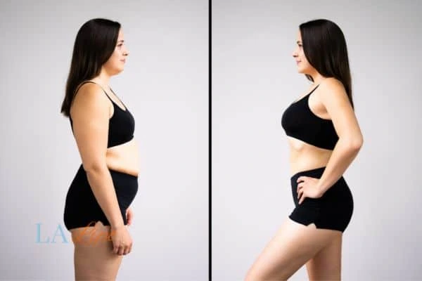 image of woman before and after results of LA-EMS Body Sculpting Newbury to help treat Diastasis recti