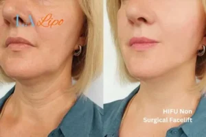 hi-fu for wrinkles Newbury before and after results