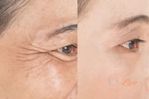 Before and after results of woman - HI-fu wrinkles reduction treatment Newbury