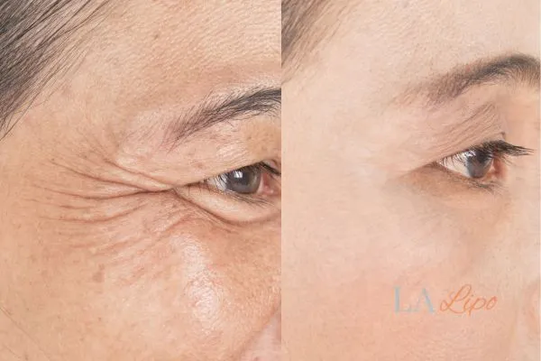 Before and after results of woman - HI-fu wrinkles reduction treatment Newbury