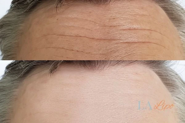results of HIFU Newbury on mans forehead to help reduce lines and wrinkles