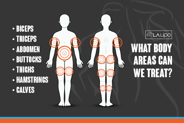 Graphic to show areas you can have LA-EMS Body Sculpting Newbury treatment.