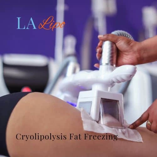 fat freezing - Cryolipolysis Newbury