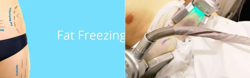 multi areas of a persons body having coolsculpting Newbury treatment