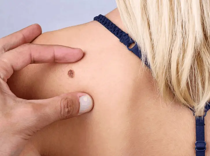 woman having mole removal Newbury consultation before treatment.