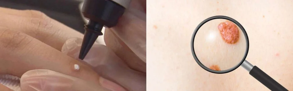Person getting moles removed with cryopen Newbury
