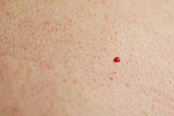 close up of a cherry angioma Newbury
