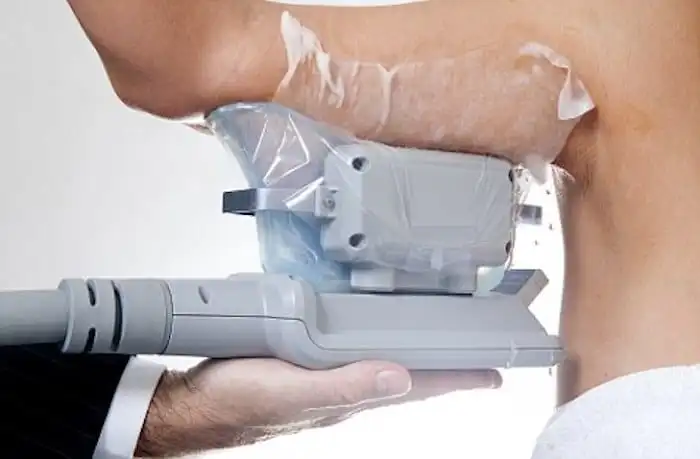 Picture of fat freezing Newbury on the upper arms.