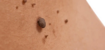 image of a skin tag Newbury
