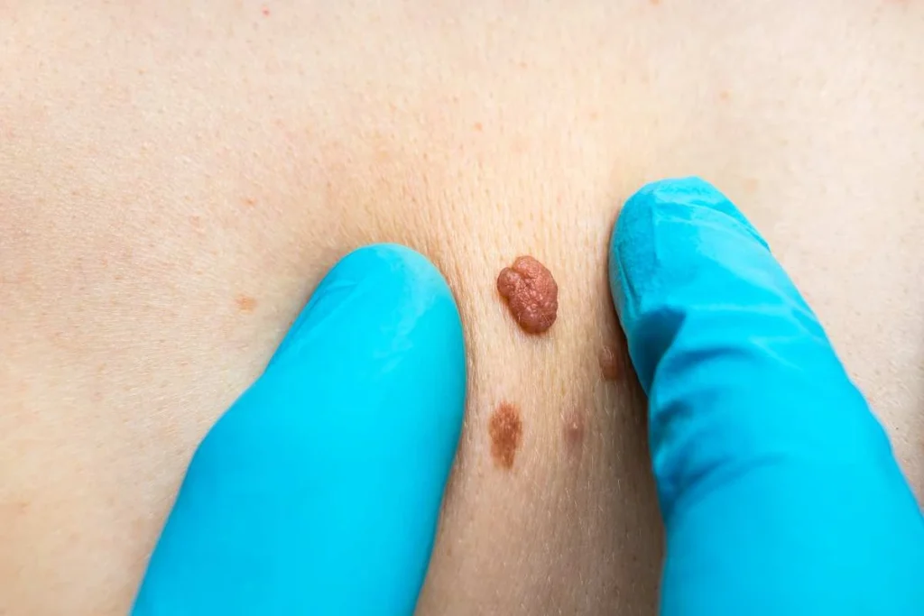 Consultant examining a skin tag Newbury