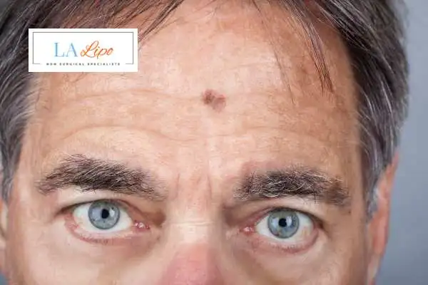 Solar Lentigo Removal Newbury image of man with mark on his forehead