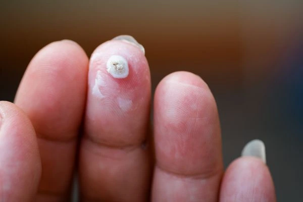 wart on person finger - cryotherapy to treat from LA LIPO Newbury
