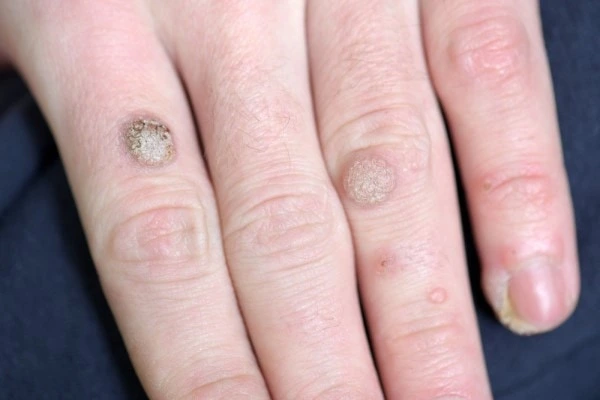 photo of warts on person hand - see wart removal Newbury from LA LIPO