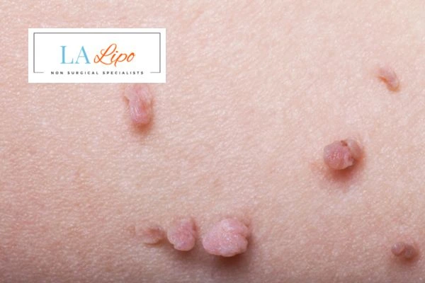 Does cryopen skin tag removal Newbury hurt? Find out now call our team today!