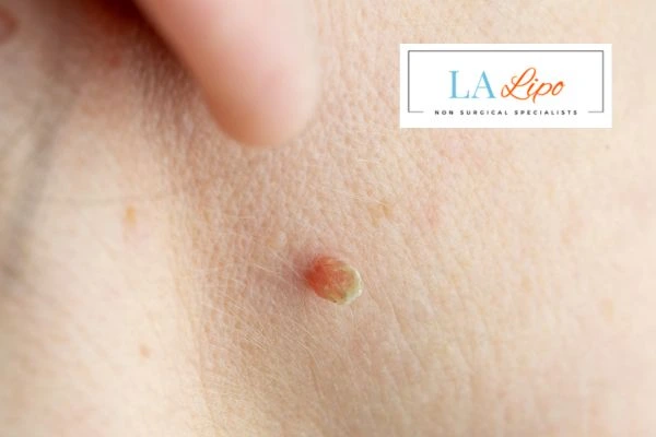 Book skin tag removal Newbury today speak to our team now!