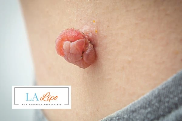 Interested in skin tag removal Newbury? Concerned about the pain? Find out more today!