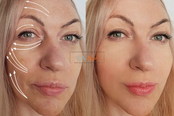 Morpheus 8 results Newbury face lift.