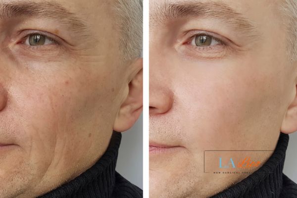 See the amazing results of Morpheus8 Treatment Newbury!