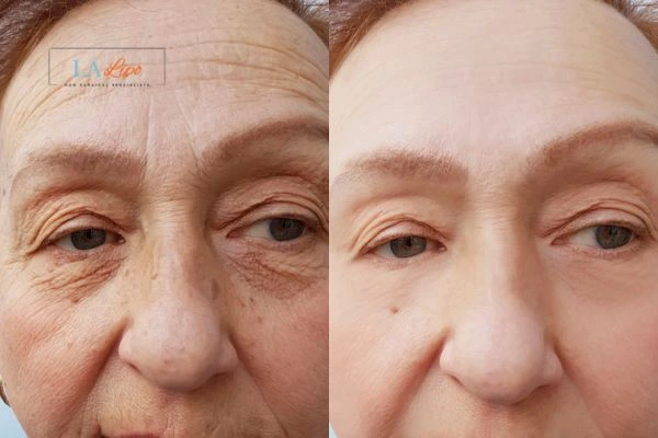 The powerful benefits of Morpheus8 Treatment Newbury - Call Our team today!