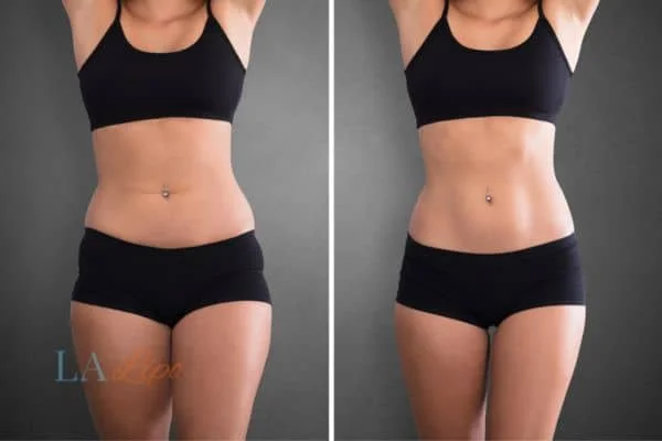 before and after results of non-surgical treatment to help a woman's body image and mental health Newbury