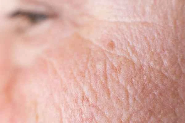 close up picture of a woman's face showing an age spot Newbury