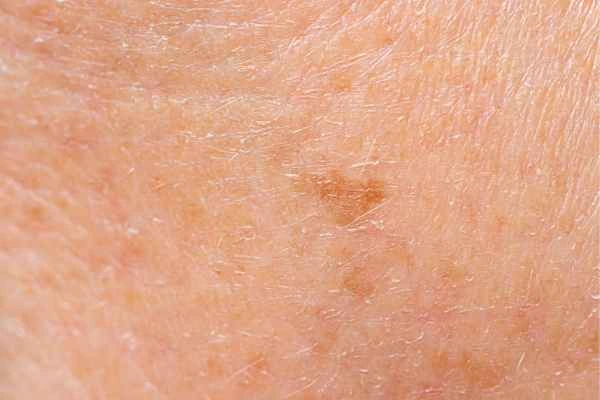 close up picture of age spots Newbury