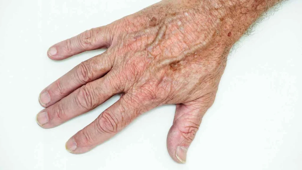 Male hand showing age spot Newbury