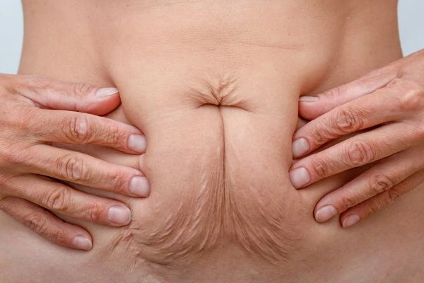 Image of a woman's stomach with loose skin - example of skin tightening Newbury options