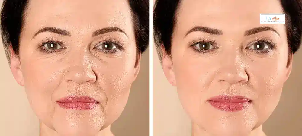 How Long Does It Take to See Results and How Long Do They Last Newbury?