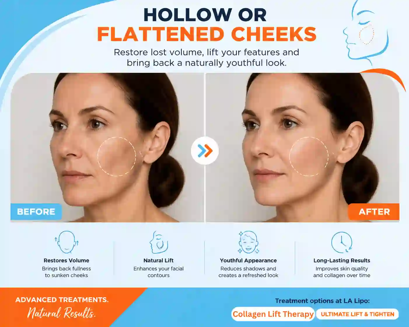 Sign #4: Hollow or Flattened Cheeks Newbury